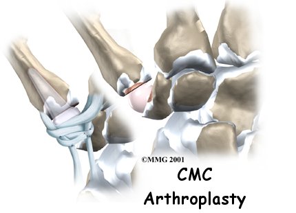 Artificial Joint Replacement of the Thumb - Energize Physical Therapy's Guide