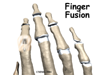 Finger Fusion Surgery - Energize Physical Therapy's Guide