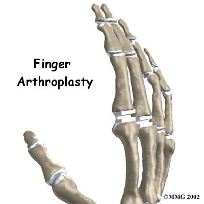 Artificial Joint Replacement of the Finger - Energize Physical Therapy's Guide