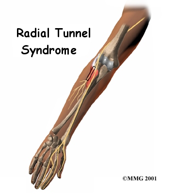 Radial Tunnel Syndrome